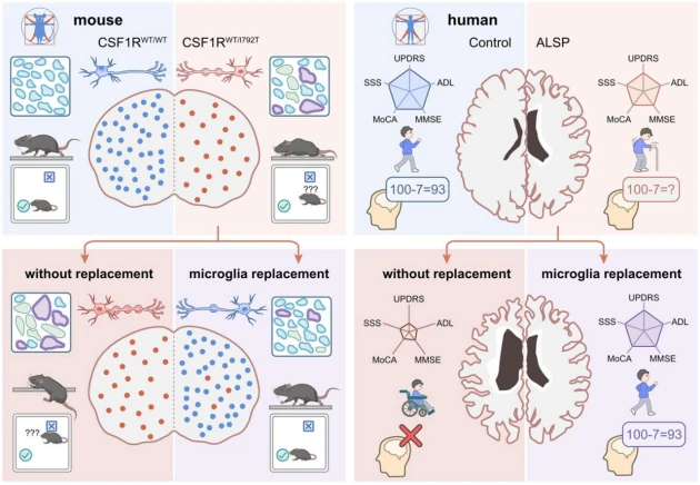 小胶质细胞替代可有效阻止ALSP的进展